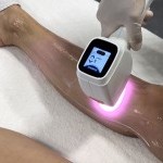 Séance d’épilation à lumière pulsée pour femme chez JFG Clinic Gaillard